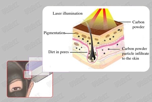 carbon blast technique